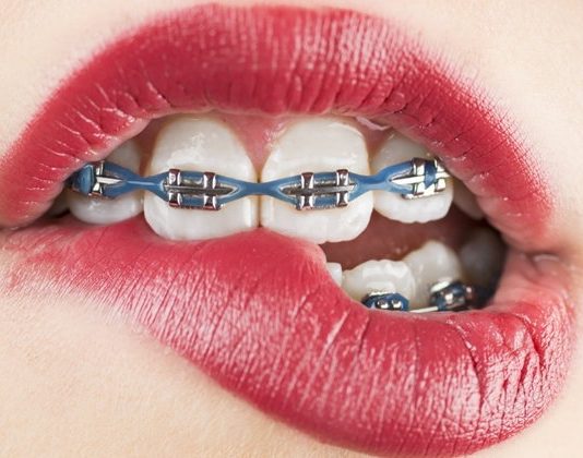 จัดฟันมีกี่แบบ จัดฟันมีกี่แบบ